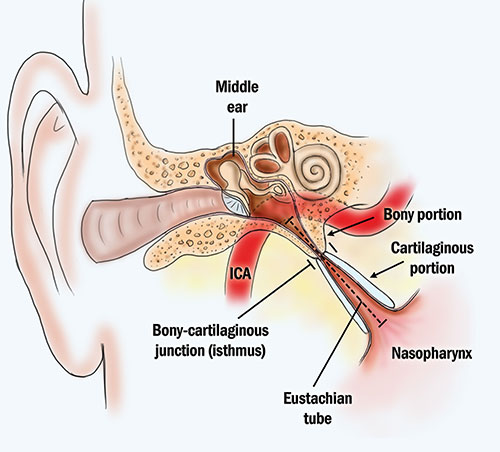 tube ear infection